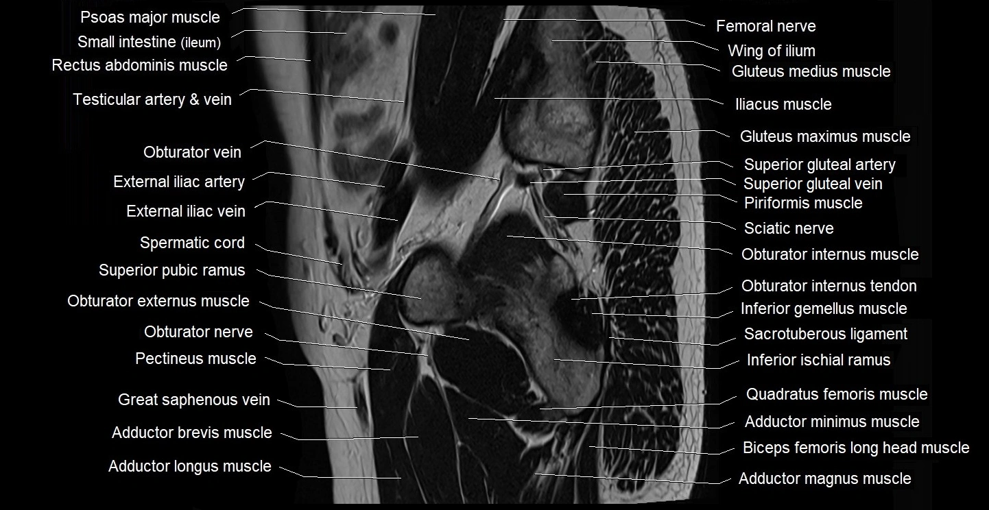 male pelvis sagittal cross sectional anatomy 3T mri image 39.webp